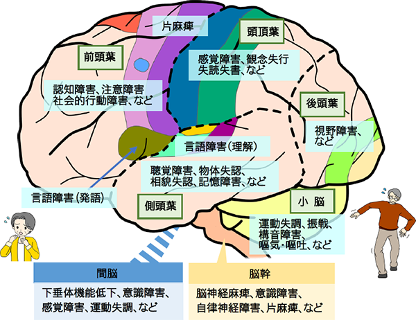 脳腫瘍の兆候と症状