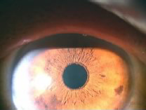 正常な角膜の写真